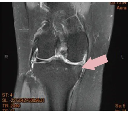 Case 1 Post-treatment MRI