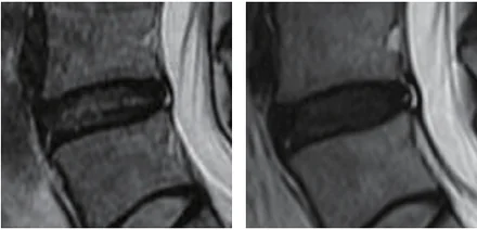 PRP MRI