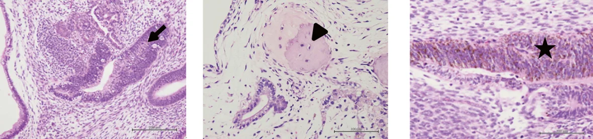 Teratoma