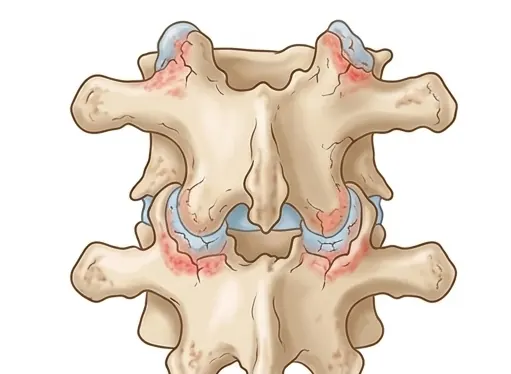 Facet Joint OA