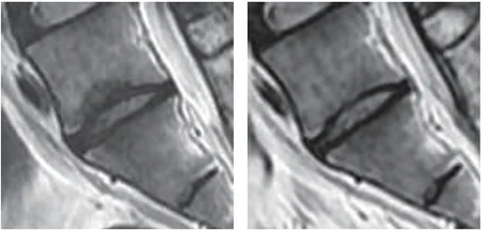 PCP MRI