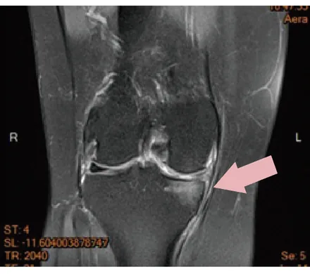 Case 1 Pre-treatment MRI