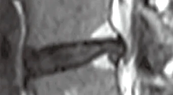 Bone Edema Pre-treatment