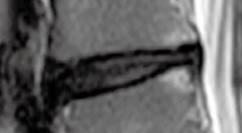 Bone Edema Post-treatment
